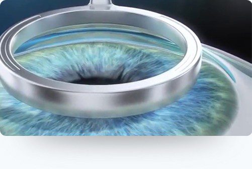 Augen Lasern: LASEK / PRK Methode